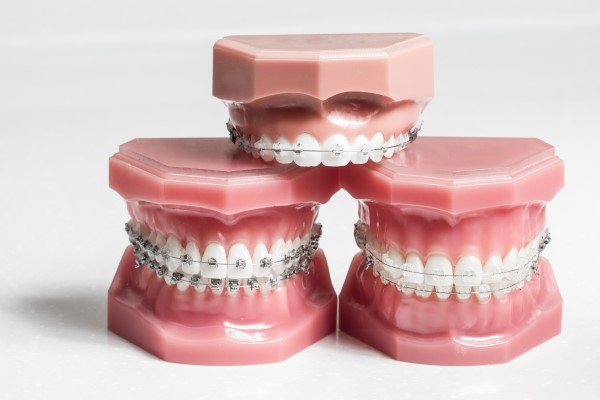 Questions To Ask Your Dentist About Affordable Braces