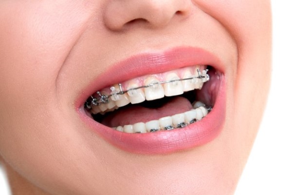 An Orthodontist Describes The Benefits Of A Healthy, Normal Bite