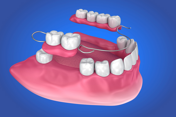 When Are Permanent Retainers A Good Choice?