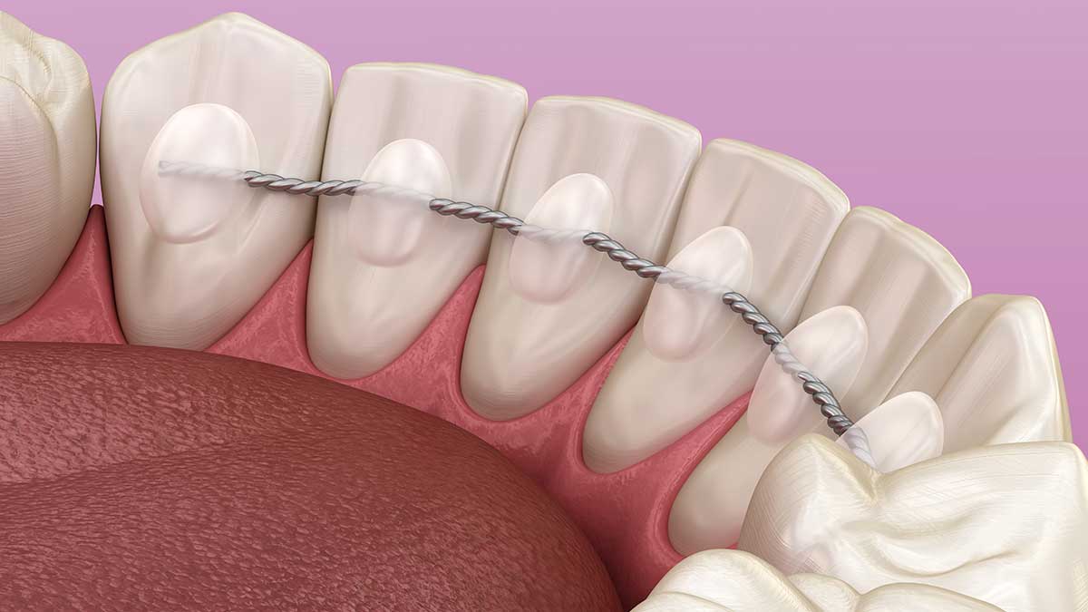 Fixed Retainers - Precision Orthodontics & Pediatric Dentistry Reston, VA  20191