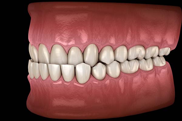 Underbite Treatment Options From An Orthodontist